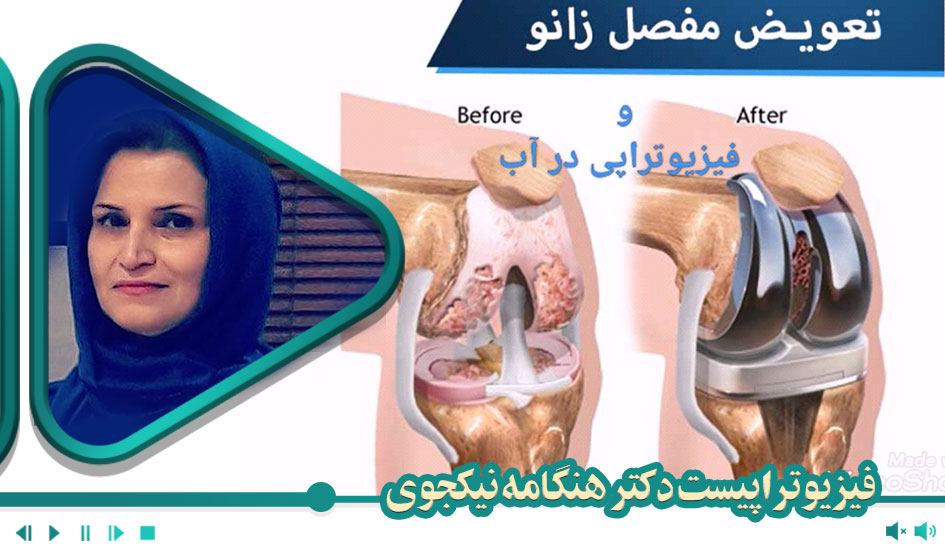 تعویض مفصل زانو و فیزیوتراپی در آب