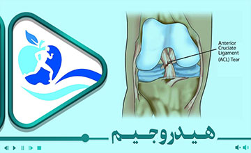 آسیب ACL و فیزیوتراپی در آب